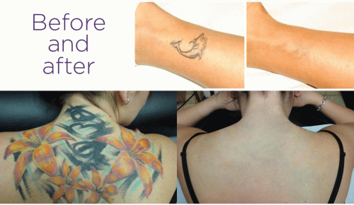 Today, people of all walks of life, ages, and skin types seek laser hair removal procedures regularly on different body parts thanks to advanced technology and affordability. Our clinic is the right stop for you. For more link:  https://www.skinfultattooremoval.com/hairremoval